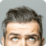 Hair Loss